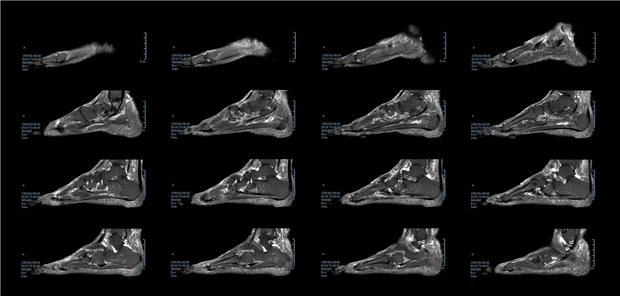 Trotz klinischer Ähnlichkeiten der geschwollenen MTP-Gelenke in beiden Kohorten offenbarte das MRT Unterschiede. So wiesen Patienten mit sowohl rheumatoider Arthritis (RA) als auch Antikörpern gegen cyclische citrullinierte Peptide (ACPA) signifikant häufiger Synovitiden, Tenosynovitiden, intermetatarsale Bursitiden (IMB) und Knochenmarködeme auf als Patienten mit RA und ohne ACPA. 