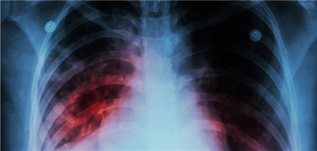Tuberkulose: Die Ukraine hat die höchste TB-Inzidenz in der WHO-Region Europa. Häufig sind dort multiresistente Erreger im Spiel.