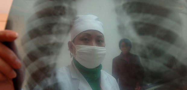 DOTS halbiert Tuberkulose-Prävalenz Tuberkulosekontrolle in China: Thorax im Röntgenbild.