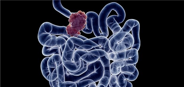 Tumor im Dünndarm: Wie hoch ist das Dünndarmkrebsrisiko bei Patienten mit CED? Eine schwedische Studie liefert neue Zahlen.