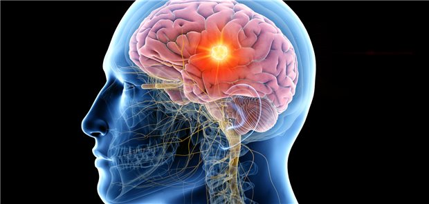 Eine Darstellung des Gehirns mit einem Tumor. 