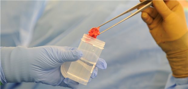 Krebspatienten haben keinen Anspruch auf vorgezogene Corona-Impfung Tumorgewebe im Labor. Unschön, aber dennoch ohne Einfluss auf die Impfhierarchie gegen Corona.