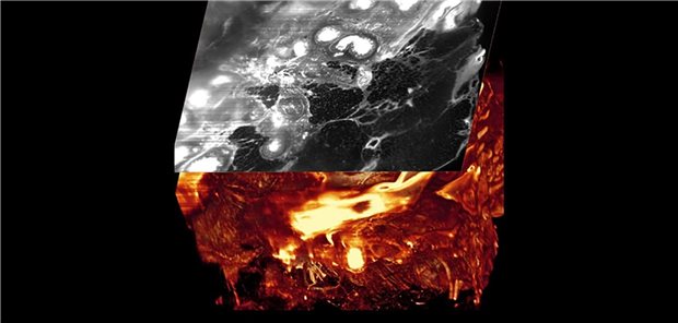 Tumorgewebe im Ultramikroskop.