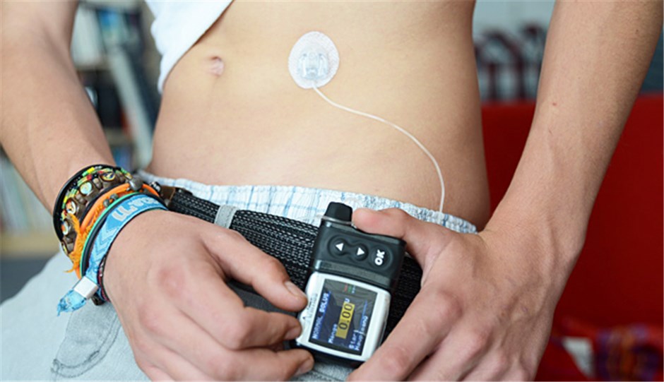 Patienten mit Insulinpumpe leben länger