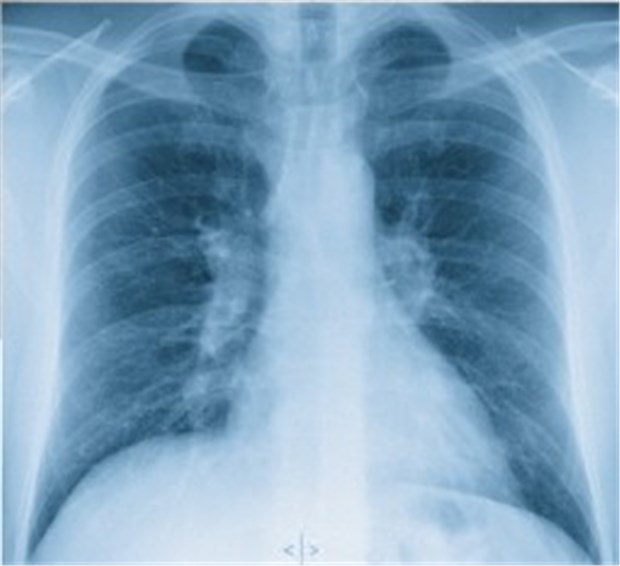 Gelenkschmerzen plus Erythem: Ist es eine akute Sarkoidose? Typisch: Auf der Thoraxaufnahme des Patienten ist eine bihiläre Lymphadenopathie zu erkennen.