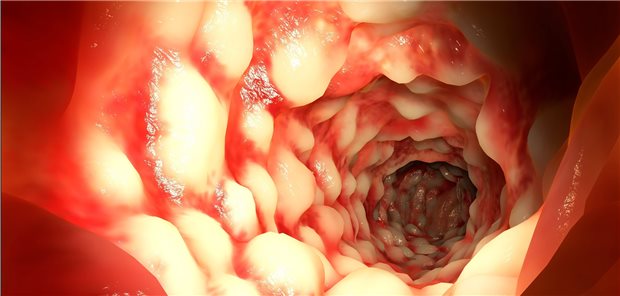 Typisch bei M. Crohn: Pflastersteinrelief der Mukosa. 