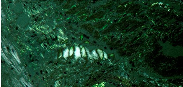 Typisch für Amyloidose: Mit Kongorot-Färbung sichtbare Eiweißablagerungen (siehe untere Abbildung). In der Polarisationsmikroskopie ist die typische apfelgrüne Doppelbrechung erkennbar (siehe diese Abbildung). 