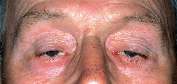 Typisch für Myasthenia gravis: Ptosis, Lidspaltenhöhe und -breite sind verkürzt.