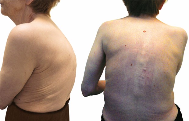 Fraktur-Prophylaxe - ein Job fürs Leben Typisch für Osteoporose-Patienten mit Wirbelkörperbrüchen: Hyperkyphosierung der Brustwirbelsäule. © Klaus Peters