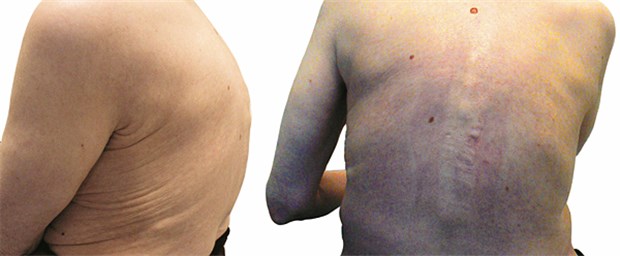 Zweites Röntgenbild entlarvt den Wirbelbruch Typisch für Osteoporose-Patienten mit Wirbelkörperbrüchen: Hyperkyphosierung der Brustwirbelsäule.