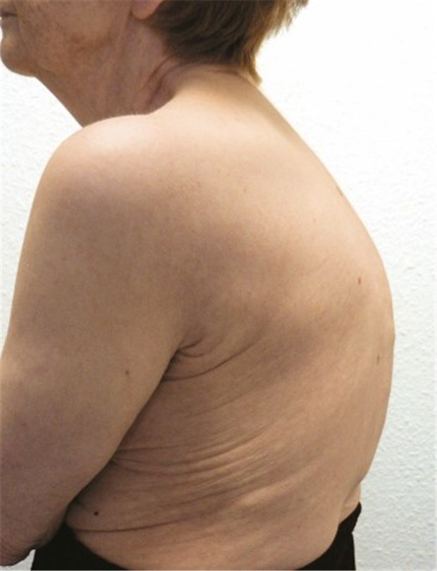 Osteoporose-Therapie bald mit Antikörpern? Typisch für eine Osteoporose: Die Hyperkyphosierung der Brustwirbelsäule.