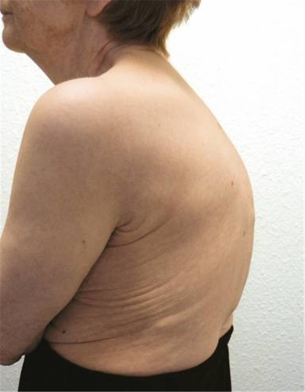 Ein Programm motiviert Patienten zur Einnahme der Osteoporose-Medikation Typisch für eine Osteoporose: Hyperkyphosierung der Brustwirbelsäule.