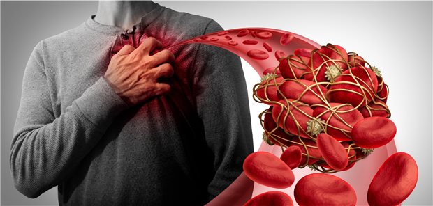 Typische Beschwerden von Lungenembolie-Patienten wie Brustschmerzen oder Beinschwellungen sind bei Embolie-Patienten mit COVID-19 seltener, dafür leiden sie wohl häufiger an Fieber, Husten und Diarrhöen als Embolie-Patienten ohne COVID.