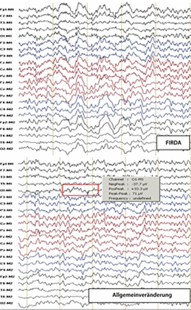 Typische EEG-Befunde beim Delir. Oben: frontal intermittierende rhythmische d-Aktivität. Unten: allgemeine Verlangsamung im Sinne einer mittelschweren Allgemeinveränderung, okzipitales Fehlen des physiologischen a-Grundrhythmus.
