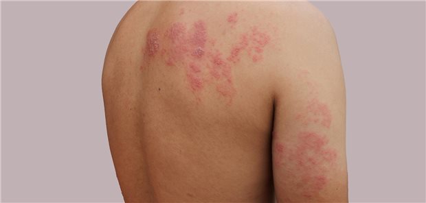 Typische Efflorenzen bei Herpes zoster