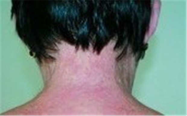 Erbkrankheit bedroht Herz, Hirn und Augen Typische Hautveränderungen mit Papeln und verdickter Haut bei einer Patientin mit Pseudoxanthoma elasticum. ©(3) Thomas Welchering