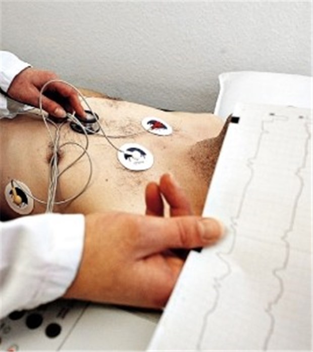 Gefahr für das Hirn bei Vorhofflimmern Typische Kennzeichen eines Vorhofflimmerns im EKG sind unregelmäßig einfallende QRS-Komplexe (absolute Arrhythmie).