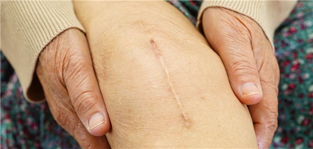 Typische Narbe nach Op mit Endoprothese: Die Heilung nach Totalersatz dauert deutlich länger als bei einer Knieteilprothese.