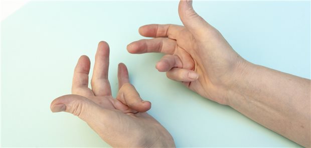 Typische verdreht Finder bei Morbus Dupuytren. Die Erkrankung ist bei Diabetes mellitus besonders häufig.