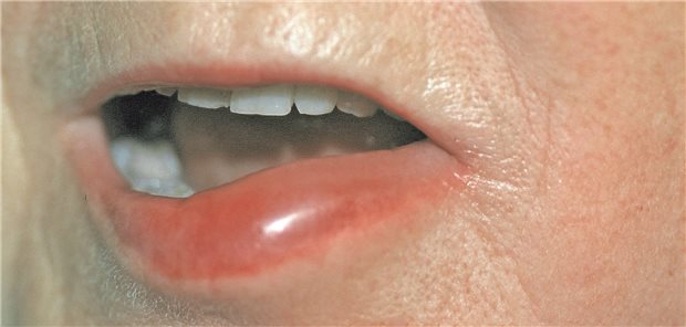 Typischer Befund bei Angioödem.
