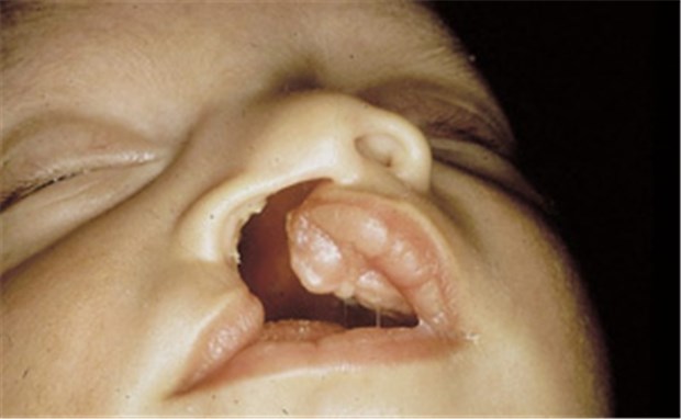 Ärzte setzen Zeichen mit der Aktion Lächeln Typischer Befund bei Lippen-Kiefer-Gaumenspalte. © PD Dr. med. Klaus Exner