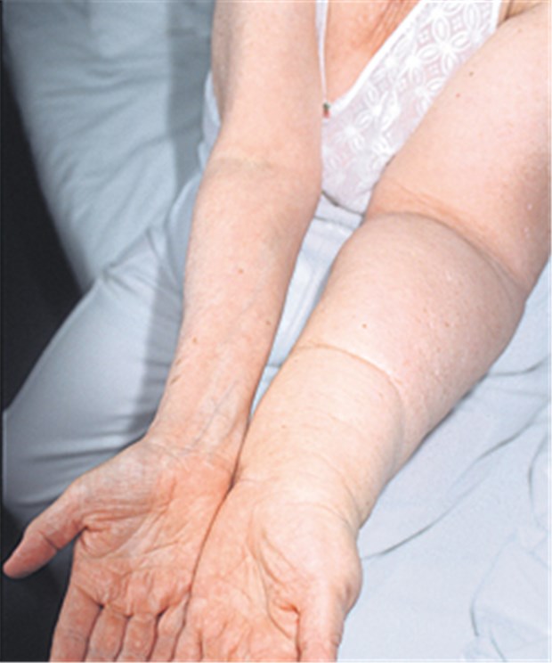 Was bei Lymphödemen hilft Typischer Befund bei Lymphödem. Wichtig ist dann auch, den betroffenen Arm nicht zusätzlich zu reizen.