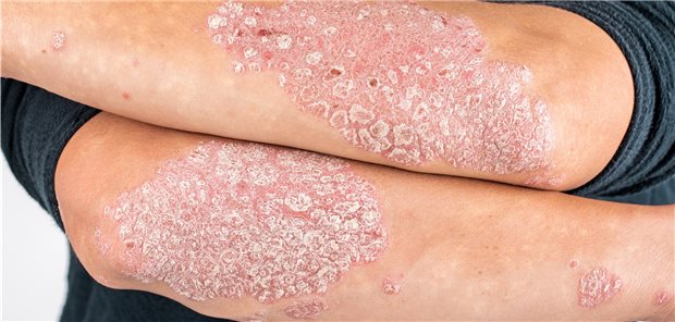 Typischer Befund bei Psoriasis. Eine neue Scanner-Technologie könnte das Therapiemonitoring unterstützen.