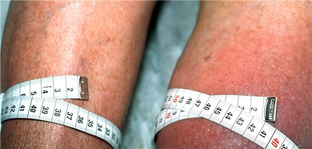 Typischer Befund bei Venenthrombose im linken Bein: Das Bein ist geschwollen und verfärbt. Krebskranke haben ein erhöhtes VTE-Risiko.