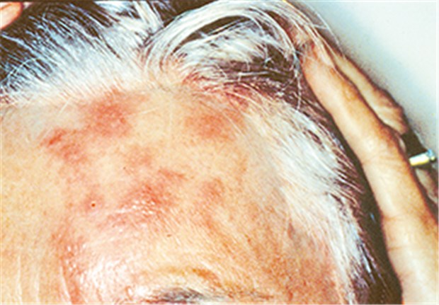 Impfung gegen Herpes zoster hat sich in den USA bewährt Typischer Befund eines Herpes zoster auf der Stirn einer älteren Patientin. Eine Impfung könnte das Erkrankungsrisiko mindern.