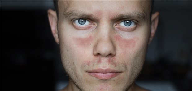 Schmetterlingserythem