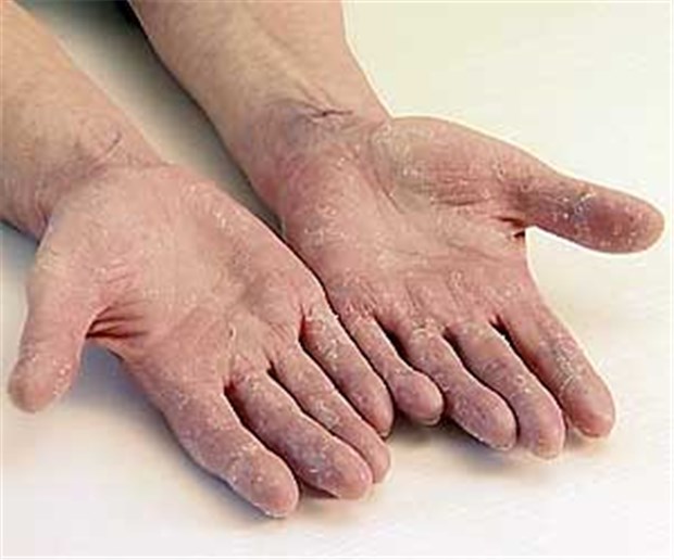 Wer Schuppenflechte hat, wird immer besser versorgt Typisches Symptom bei Psoriasis ist die Hautschuppung.