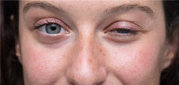 Typisches Zeichen einer Myasthenie: Die Ptose, also das Hängen eines oder beider Augenlider (Symbolbild mit Fotomodell).