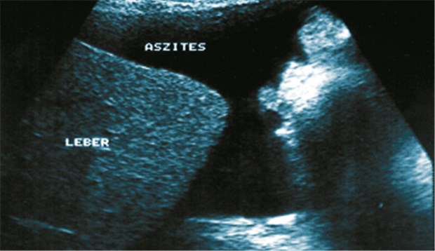 Bei Fettleber leiden andere Organe mit Typisches sonografisches Bild bei einem Patienten mit fortgeschrittener Leberzirrhose und Aszites. Auch nicht-alkoholische Steatohepatitis (NASH) kann in Leberzirrhose übergehen. © MRI