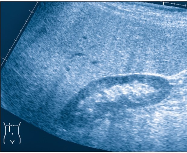 Zahl der Patienten mit Fettleber steigt Typisches sonografisches Bild einer massiven Fettleber. Das Gewebe ist wesentlich echoreicher als das Nierenparenchym.