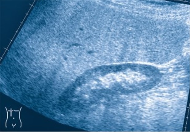 NASH mit Fibrose - da ist Differenzialtherapie gefragt Typisches sonografisches Bild einer massiven Fettleber. Das Gewebe ist wesentlich echoreicher als das Nierenparenchym.