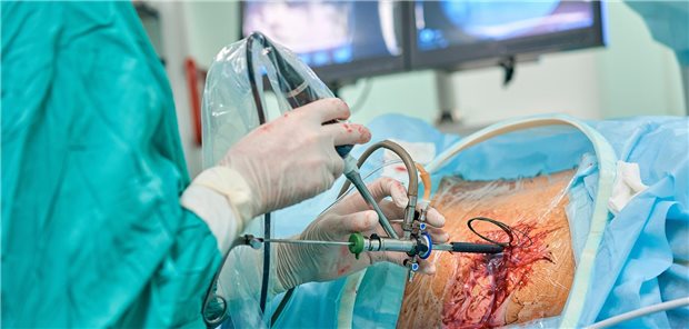 Über die Jahre hinweg sind in Deutschland immer weniger Nierenlebendspenden (NLS) offen durchgeführt worden (von 82 Prozent in 2006 auf 22 Prozent in 2020). Dafür ist der Anteil der minimalinvasiven Organentnahmen kontinuierlich gestiegen (von 18 Prozent in 2006 auf 70 Prozent in 2020). (Symbolbild)