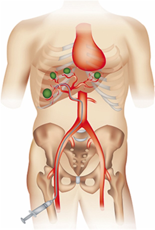 Krebstherapie mit strahlenden Mikropartikeln Über die Oberschenkelarterie nahe der rechten Leiste wird ein Katheter durch die Arterie in die Leber eingeführt. Durch diesen Katheter werden die SIR-Spheres Mikrosphären direkt in die Tumoren der Leber verabreicht.