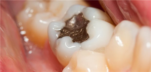 Amalgam-Verbot greift ab 1. Januar Über die gesundheitlichen Folgen von Amalgam-Füllungen wird seit Jahren diskutiert.
