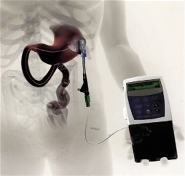 Pumpsystem erleichtert die Parkinson-Therapie