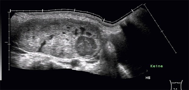 Mit neoadjuvanter Therapie bei fortgeschrittenem Ovarial-Ca in Vorteil ? Überlebensvorteil beim fortgeschrittenen Ovarialkarzinom duch neoadjuvante Chemotherapie.