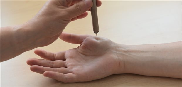 Überprüfung der Schmerzwahrnehmung: Bei der quantitativ sensorischen Testung wird die Empfindlichkeit der Betroffenen auf verschiedene Reize gemessen, beispielsweise auf spitze Reize.