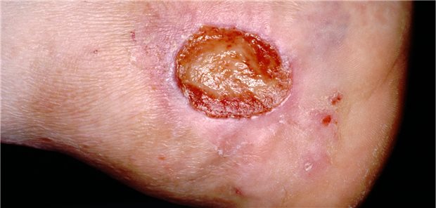 Ulcus cruris: Bei geriatrischen Patienten geht es vor allem um den Erhalt von Lebensqualität. 