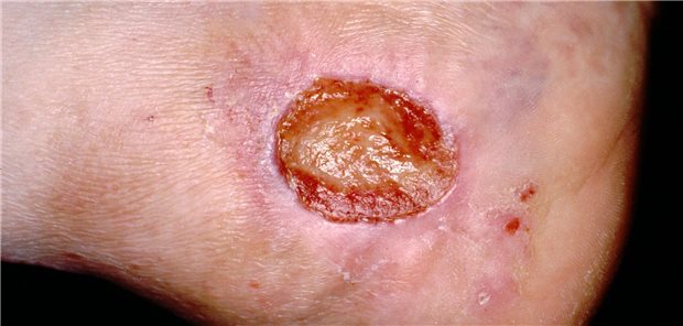 Ulcus cruris in der Knöchelregion. Eine neue Therapie mit mesenchymalen Stromazellen wird bei Betroffenen jetzt in einer randomisierten Studie geprüft.
