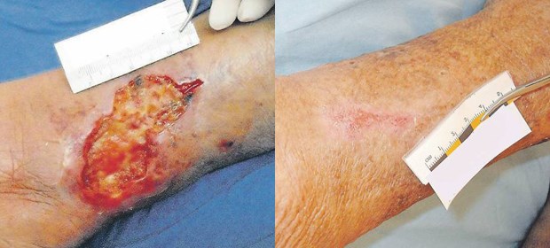 Ulcus cruris mixtum am linken Knöchel bei einer 68-jährigen Patientin (links), das Geschwür ist abgeheilt, nachdem sie zwölf Wochen mit einem Hämoglobin-Spray behandelt worden war.