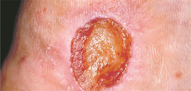 Ulcus-Versorgung längst nicht optimal Ulcus cruris venosum: Eine primär venöse Genese liegt nur bei jedem zweiten Ulkus vor.
