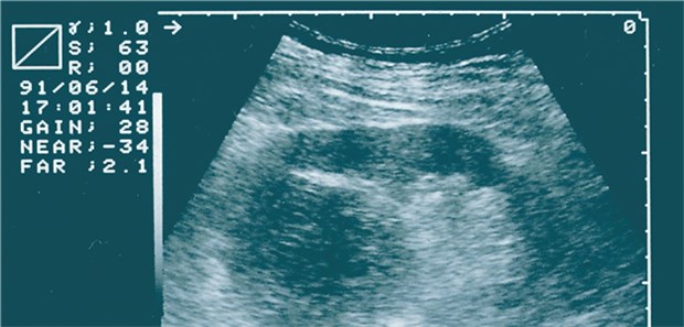 Ultraschall-Aufnahme bei einem Patienten mit einem metastasierten Nierenzellkarzinom.