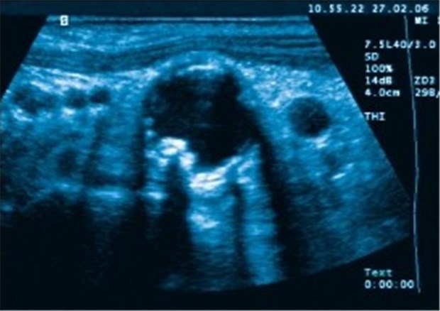 Erstes bei pAVK-Verdacht: Ultraschall Ultraschall: Bauchaortenektasie, verkalkte Plaques. Zur Diagnose ist keine CT nötig.
