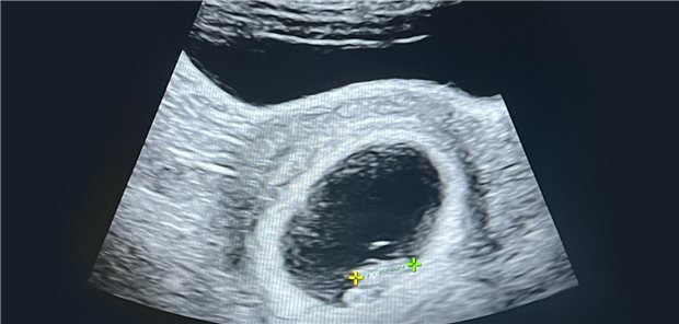 Ultraschall aus der achten Schwangerschaftswoche