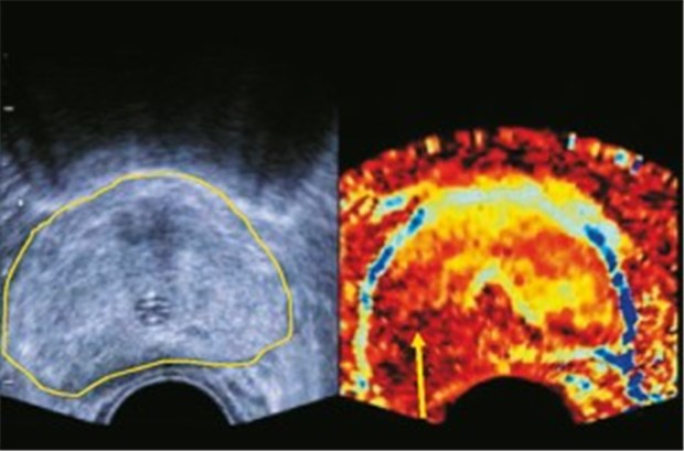 "Active surveillance" - eine neue Option bei lokalisiertem Tumor? Ultraschall bei einem Prostata-Ca (oben). Mit Elastografie (unten) ist der Tumor als dunkle Region (Pfeil) zu erkennen.