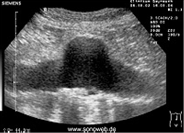 Aufruf zum Schallen der Bauchaorta Ultraschall der Bauchaorta (dunkel) im Längsschnitt, in der Mitte ein Aneurysma mit knapp doppeltem Durchmesser der Aorta. © www.sonoweb.de